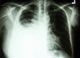 Патологическое скопление жидкости. Pleural Effusion.