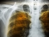 Обоих легких. Рентген грудной клетки туберкулез. Infiltrative Pulmonary tuberculosis x ray. Рентген легких звездное небо.