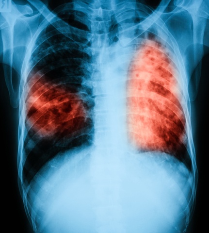 What is Tuberculosis (TB) and How Can I Get It?