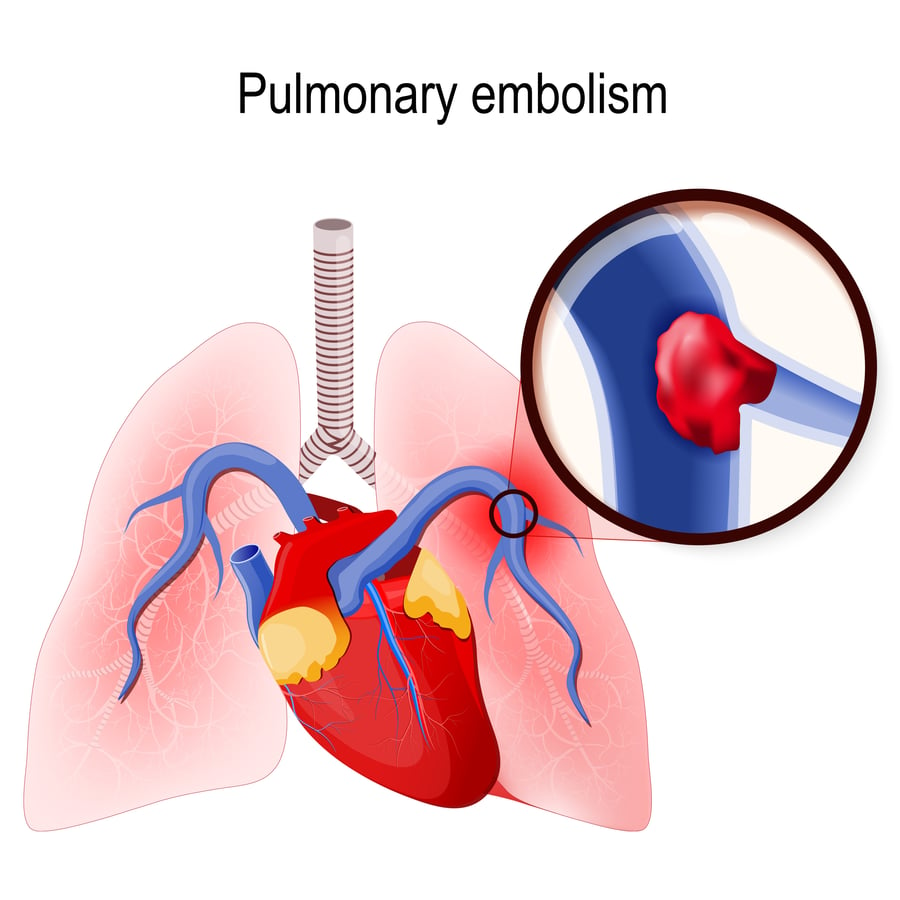 Pulmonary Embolism What You Need To Know