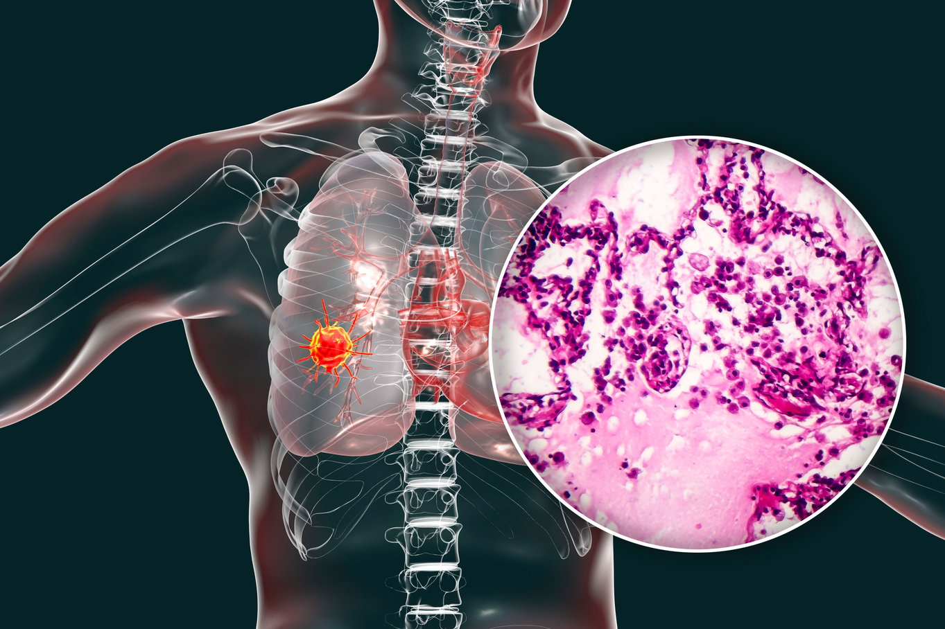 what-you-should-know-about-bronchogenic-carcinoma