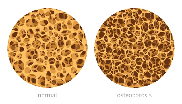 The Science Behind Corticosteroids and Bone Loss