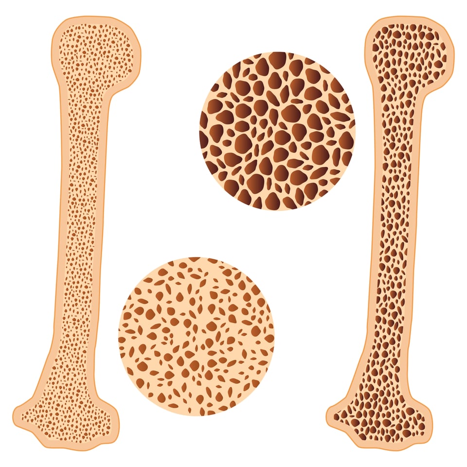 Bone loss