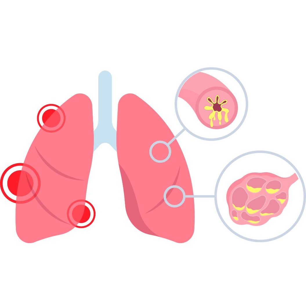 Managing and Preventing COPD Flare-ups: A Comprehensive Guide