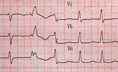 ekg results